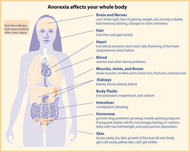 anorexia facts and statistics